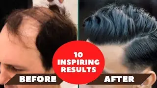 10 Impressive Hair Transplant Results (Natural hairlines!)