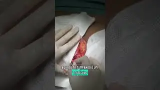 Detalhes da Neovagina da Mulher Trans