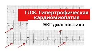 Гипертрофия левого желудочка. Гипертрофическая кардиомиопатия. Как распознать по ЭКГ?