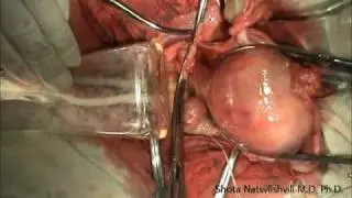 Total Abdominal Hysterectomy. Uterine Fibroids