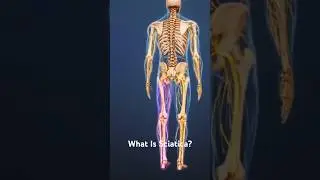 What Is Sciatica?
