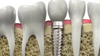 Implantes Dentales, Houston, Texas