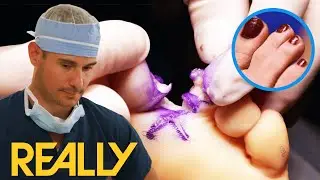 Patient Nearly Loses Toe In 