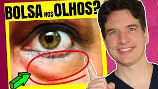 Como se LIVRAR das BOLSAS dos OLHOS? 5 Dicas Naturais que REALMENTE Funcionam!