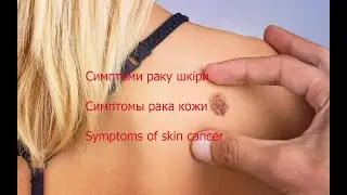 Важные симптомы рака кожи