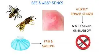 NURSING STUDENT'S GUIDE: Scorpion Stings, Bee/Wasp Stings, & Snake Bites