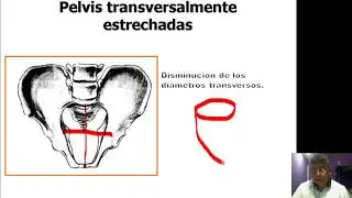 Distocia osea