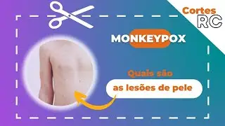 Monkeypox - como são as lesões de pele