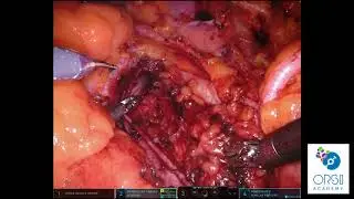 Retroperitoneal node dissection for prostate cancer