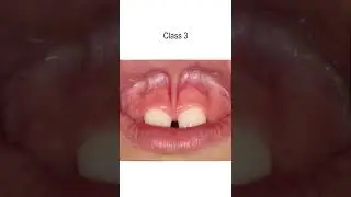 Upper Lip Tie Class 1 - 4 