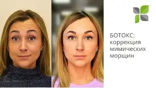 БОТОКС: коррекция мимических морщин