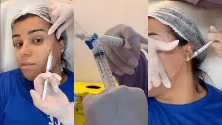 APLICANDO 8 ML DE RADIESSE NO MEU ROSTO
