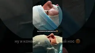 Этапы подтяжки шеи, пластики носа и результат через 2 дня #платизмопластика #ринопластика