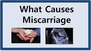 What Causes Miscarriage, اسقاط حمل کی وجہ کیا ہے؟