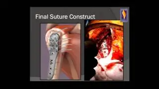 Principles of ORIF for proximal humerus fractures