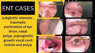 subglottic stenosis | traumatic perforation of TM | vocal cord nodule & polyp| supraglottic growth