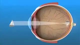 Visión de Cerca _ Miopía _ Palomera Ópticos Mislata