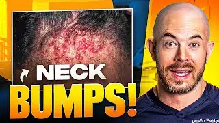 Doctor Discovers Cause of Patient's Condition - Acne Keloidalis Nuchae