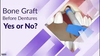 Bone Graft Before Dentures: Yes or No?