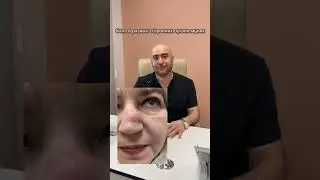 Клинический случай хирурга-онколога М.Э.Тарба. Эпидермальная киста спинки носа 🔥