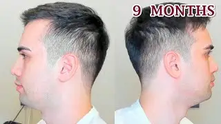 Uncovering the Secret To Hair Loss Treatment for Men - Stop Balding NOW