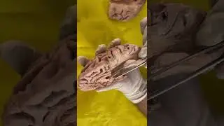 Hippocampus of Brain | Lateral ventricle of Brain