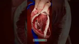 Comparing Healthy Heart vs. Myocarditis 🫀 | Complete Anatomy