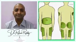How to Rotate Insulin injection sites? Dr Rahul Reddy