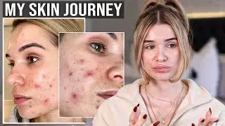 My Skin Story... Going on ACCUTANE
