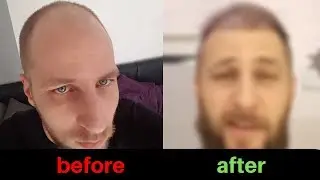 fue hair transplant after alopecia 17 weeks result