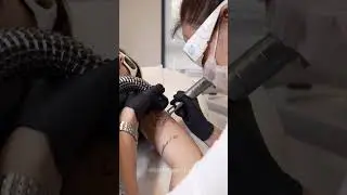 Лазерное удаление тату на руке. Процесс удаления татуировки неодимовым лазером. Приходи, удаляй!