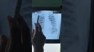 Foto thorax (Algoritma ABCDE) | @dr.bobrambe
