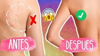 QUITA ACNÉ Y MANCHAS DE TU ESPALDA 😱✅