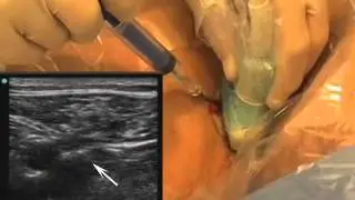 Placement of a Femoral Venous Catheter NEJM