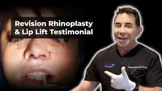 Rhinoplasty with Lip Lift Transformation | Dr. Paul Nassif