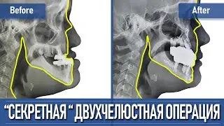 Исправление прикуса - двухчелюстная операция в Корее