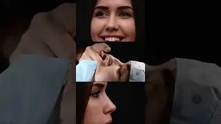 Rhinoplasty result ⭕️ KAMINSKYI