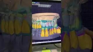 Patient wants long teeth!