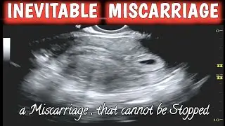 Inevitable Miscarriage - Early Pregnancy- Missed Abortion
