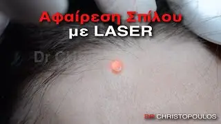 Αφαίρεση σπίλου με laser - Πλαστικός Χειρουργός