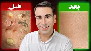زگیل تناسلی چیست؟ آیا زگیل خطرناک است؟ چند نوع زگیل داریم؟ چیکار کنیم زگیل از بین برود؟