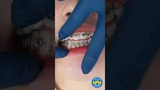 Do Braces Hurt? 