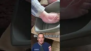 DOCTOR REACTS : POPPING HUGE BLISTER! 😱 