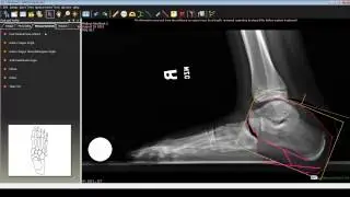 Foot and Ankle Deformity Correction with Dr. Noman Siddiqui - Flat foot Deformity