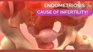 Endometriosis |Cause of Infertility | Endometriosis Diagnosis & Treatment |
