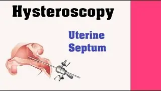 Hysteroscopy - Uterine Septum