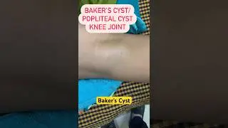 Baker’s cyst in the knee joint #knee #joint #patient #kneepain #swelling #degeneration #pain #USG
