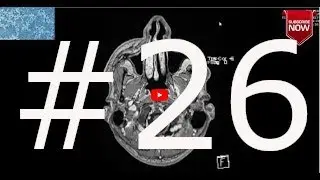 #26 My MRI images leading to the diagnosis of multiple sclerosis