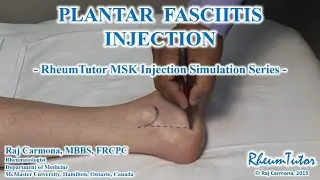 PLANTAR FASCIITIS INJECTION: Step-By-Step Instructions