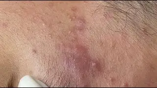 Big cystic acne #HoangMySpa107